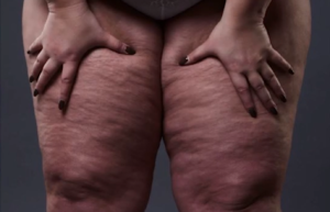Lipedema: doença pouco conhecida desafia diagnóstico