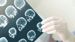 Mais da metade dos casos de demência pode ser evitada