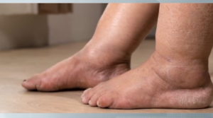 Lipedema: doença pouco conhecida desafia mulheres no Brasil